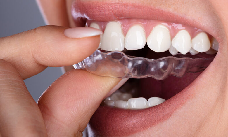 Invisalign